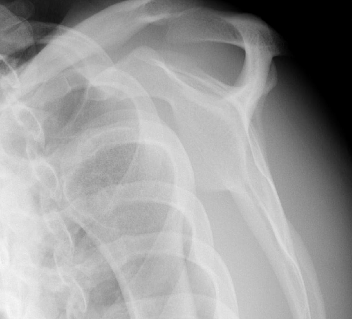 Anterior Shoulder Dislocation0002